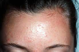 Fungal acne mirip beruntusan ,ternyata berbeda! Ini tips mengatasinya